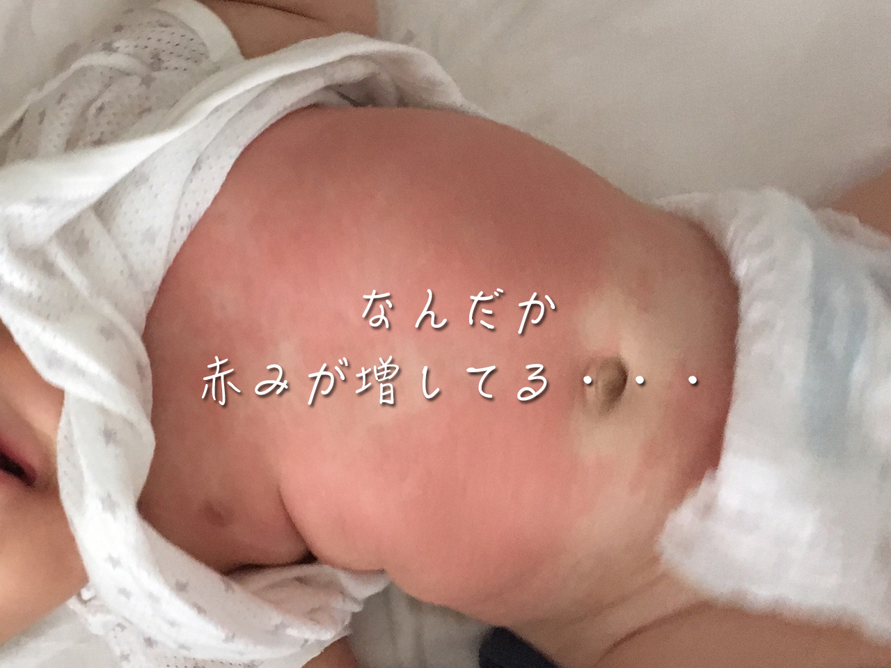 プランテーション 広告 おもしろい 赤ちゃん お腹 背中 湿疹 Hana Mochi Jp